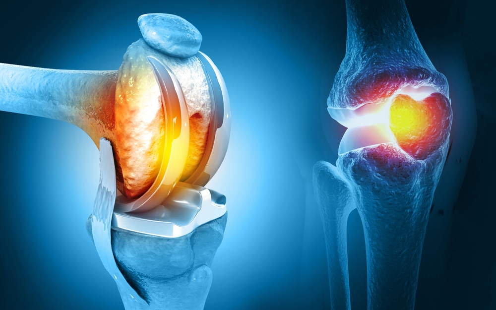 Is Joint Replacement Surgery Safe in Elderly People?