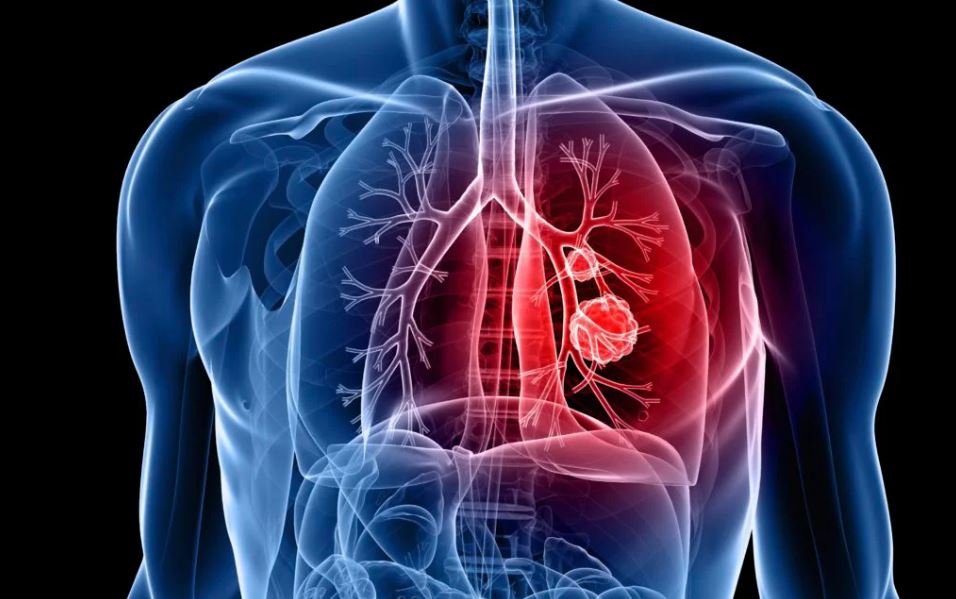 When Do You Need Thoracic Surgery? Signs, Benefits, and Recovery